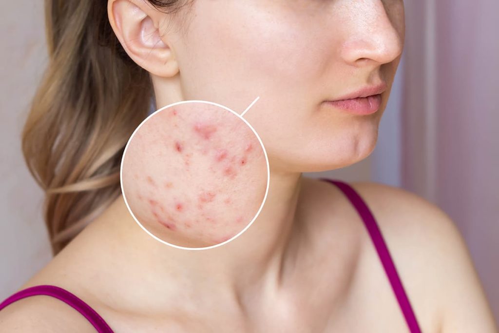 Si può usare l’acido ialuronico sulla pelle impura?